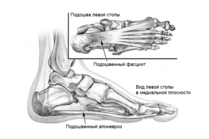 Миниатюра для записи Плантарный фасциит у спортсменов